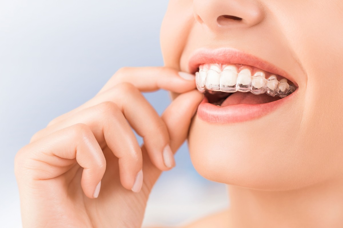 Descubre el nuevo método de ortodoncia invisible